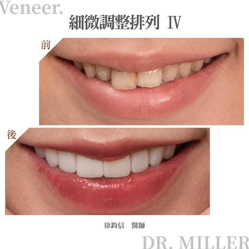 前牙美學案例分享一：細微調整排列-4.jpg