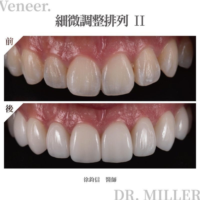 前牙美學案例分享一：細微調整排列-2.jpg
