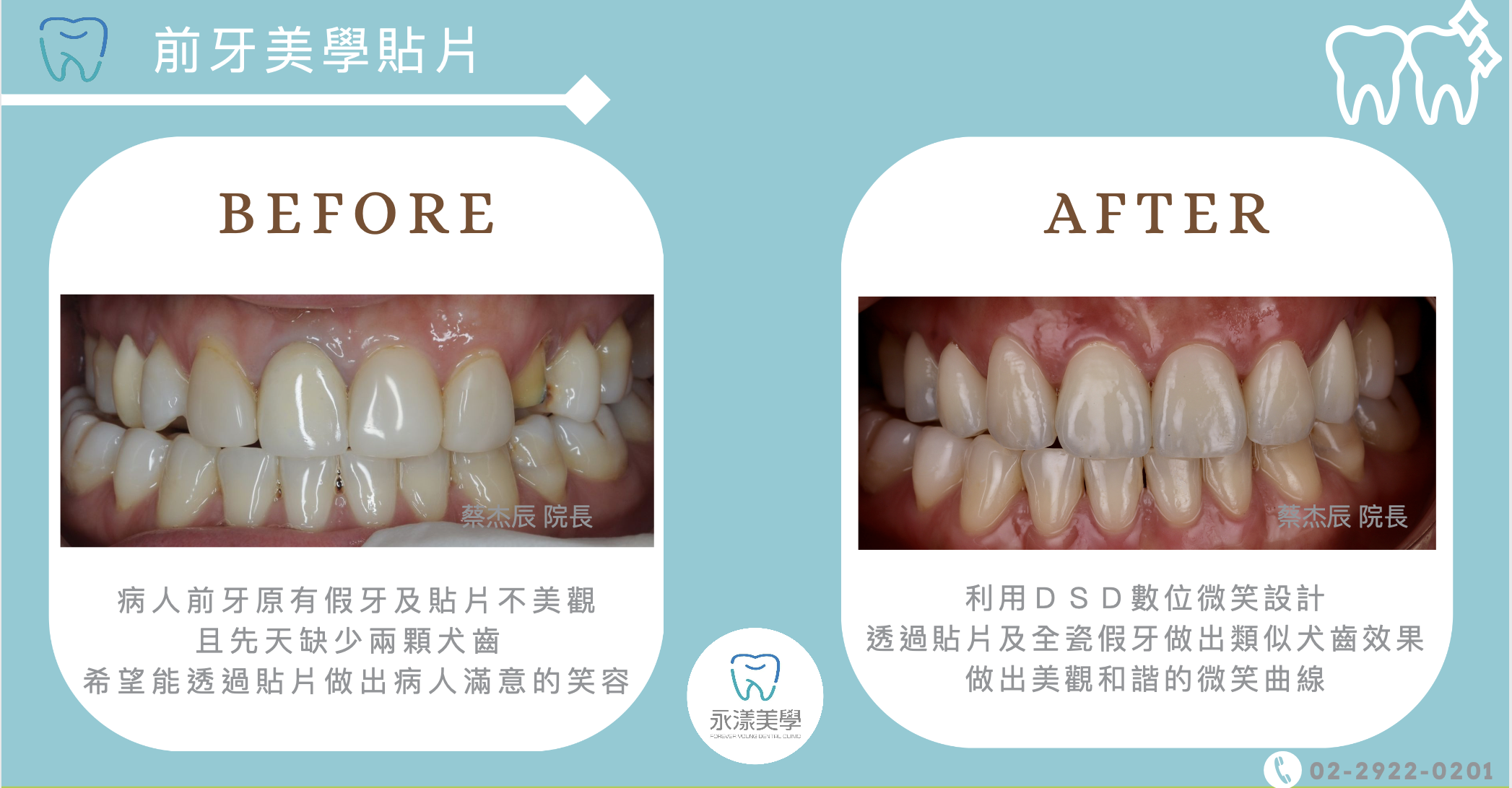 前牙貼片混合全瓷冠.PNG
