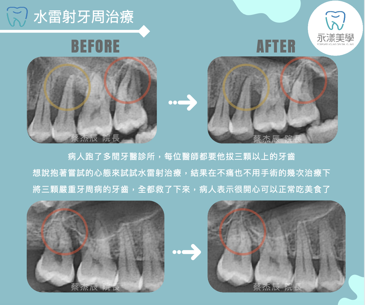 水雷射牙周治療.png