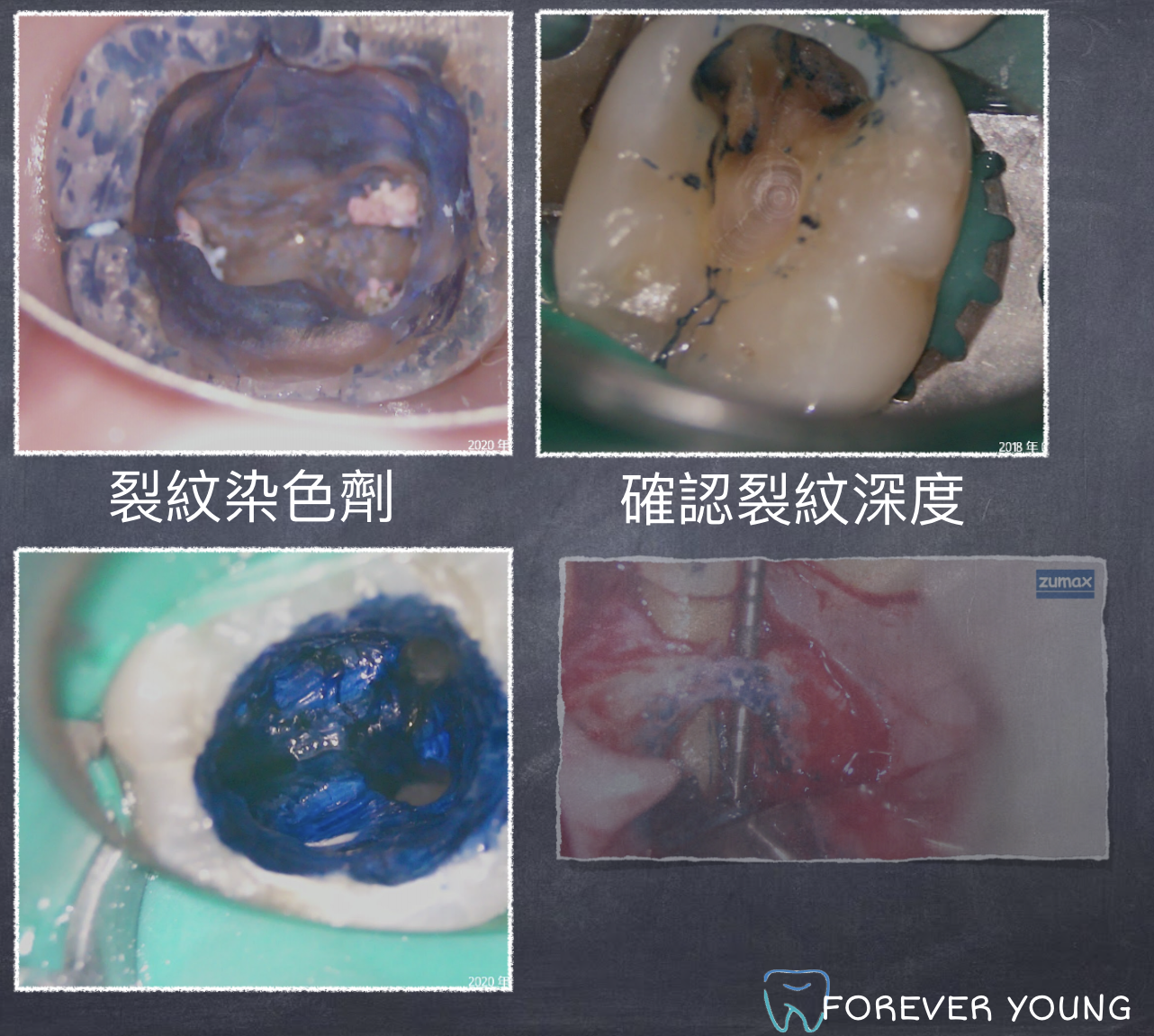 顯微根管治療案例二:顯微鏡確認牙齒裂紋、牙根裂紋深度.png