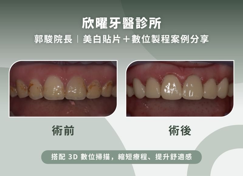 欣曜牙醫診所郭駿院長-美白貼片+數位製程案例分享.jpg