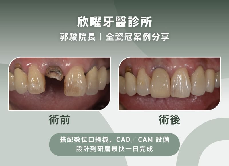 欣曜牙醫診所郭駿院長-全瓷冠案例分享.jpg
