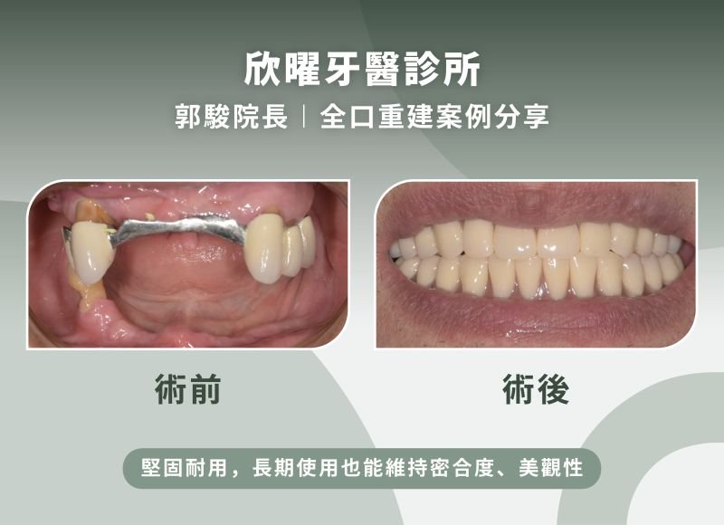欣曜牙醫診所郭駿院長-全口重建案例分享.jpg