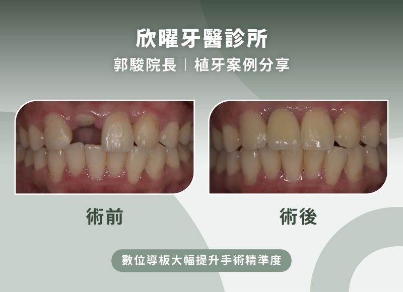 欣曜牙醫診所郭駿院長-植牙案例分享.jpg