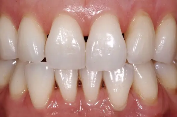 牙齒跟牙齒之間的黑色三角縫隙.webp