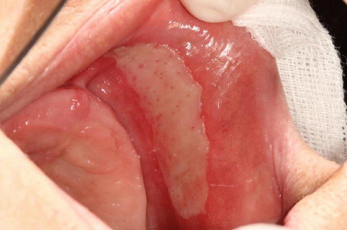 藥物性口腔炎.jpg