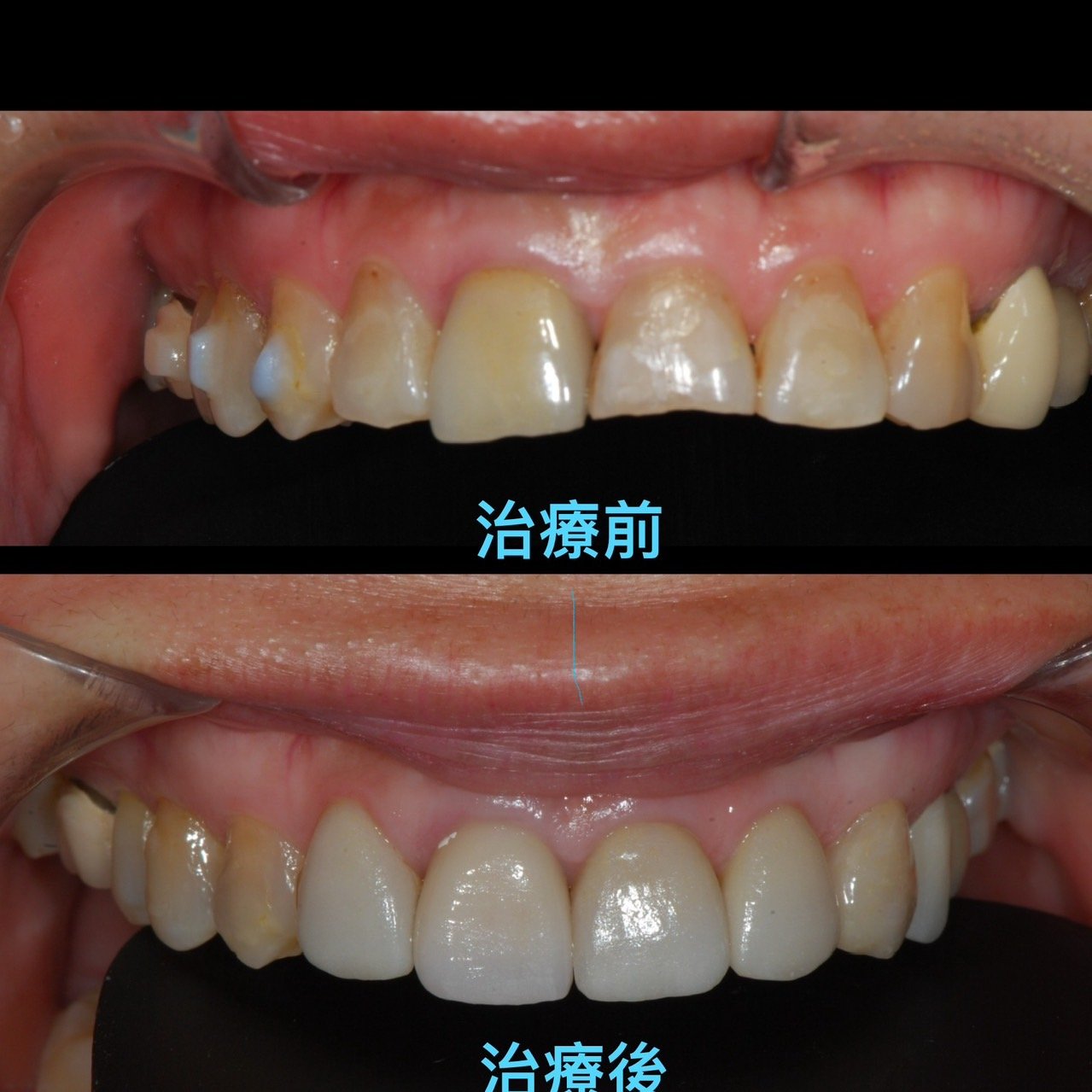 夜間磨牙，牙周病，隱適美治療後貼片重建笑容.jpg