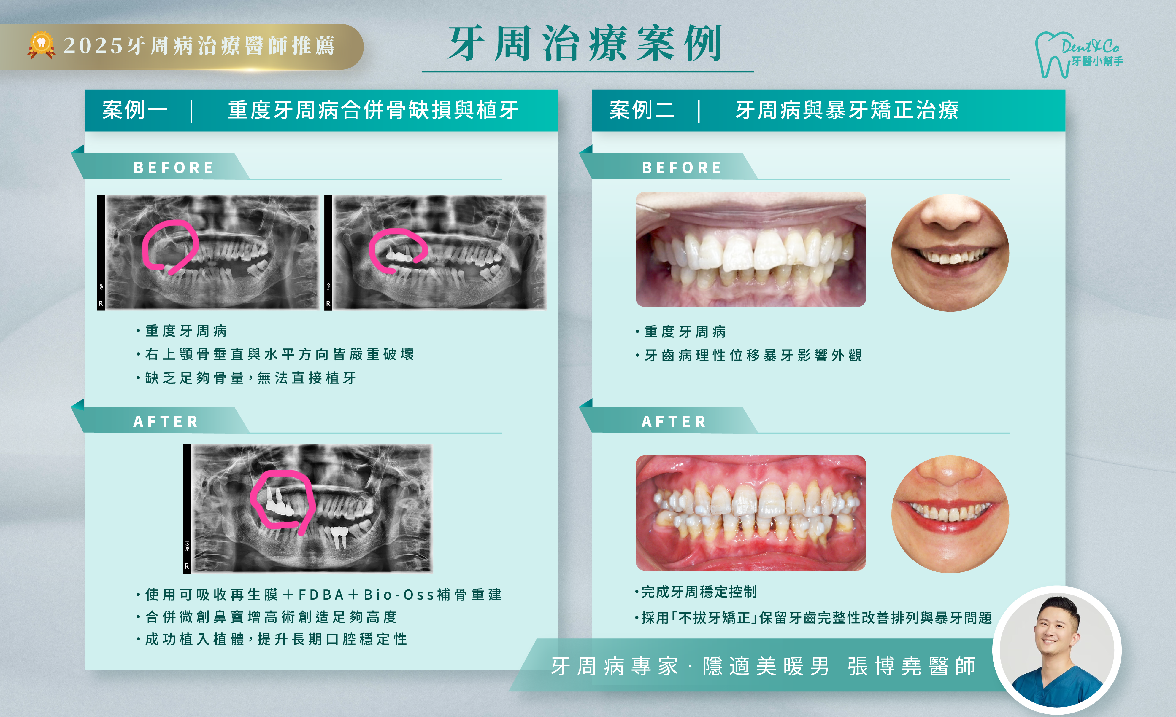 張博堯醫師牙周治療案例分享.png