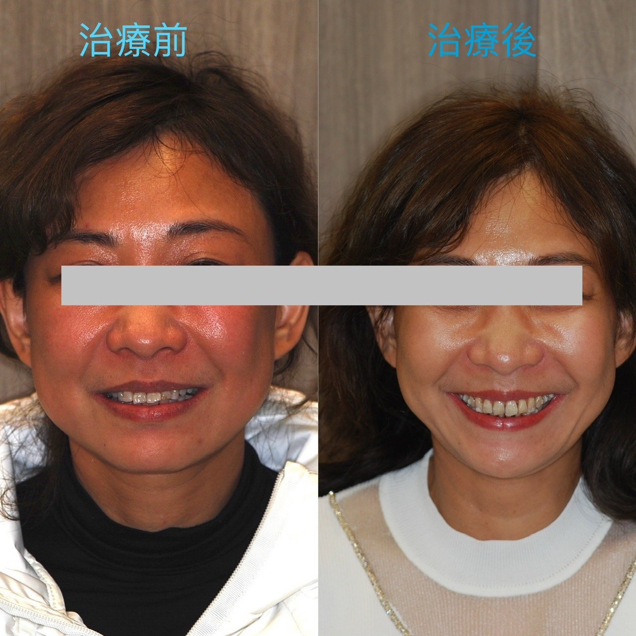 重度牙周病暴牙，牙周治療後隱適美不拔牙改善暴牙.jpg