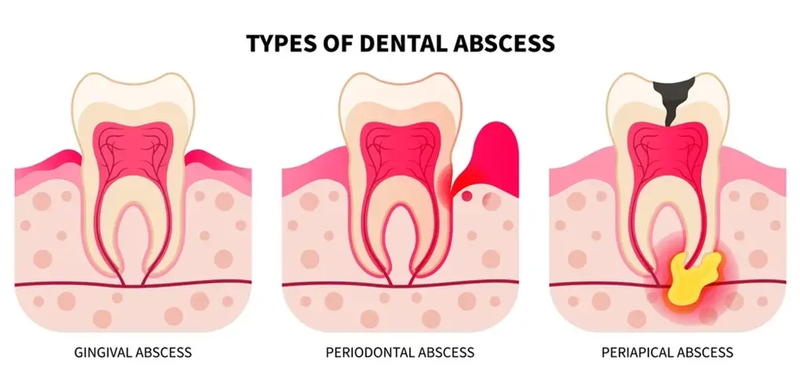 牙齦、牙周、根尖膿腫的類型示意圖，圖片來源：DentalZORG