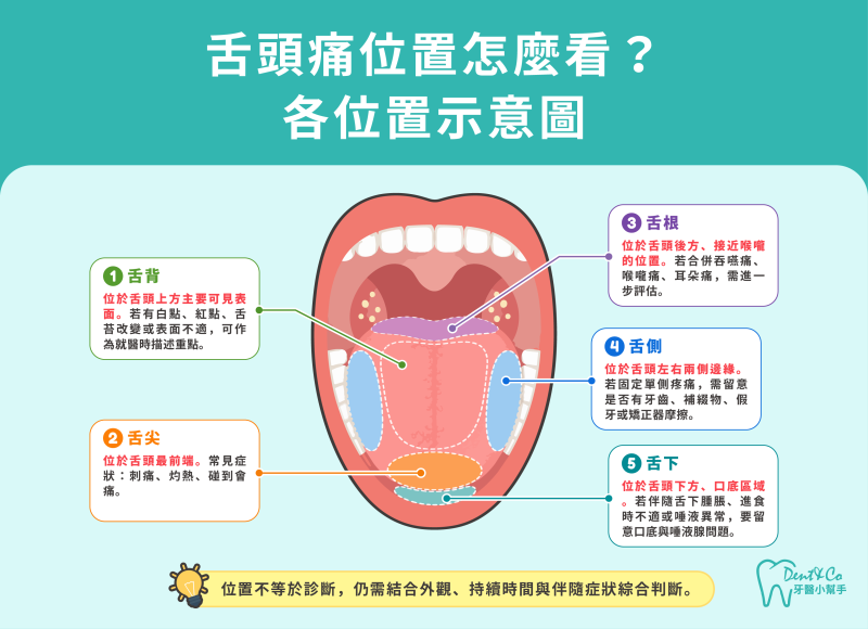 舌頭痛位置示意圖：舌背、舌尖、舌根、舌側與舌下