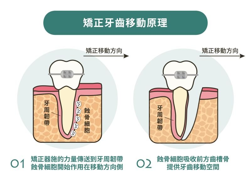 牙齒矯正原理示意圖之一。