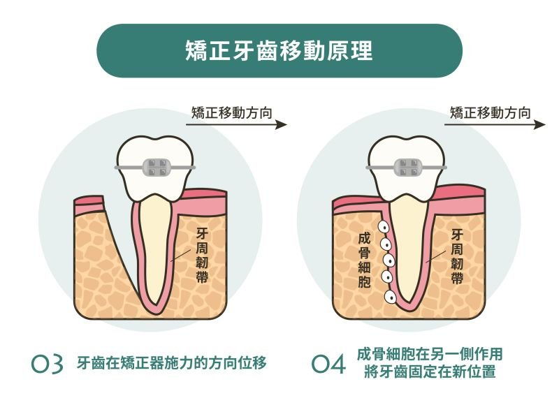 牙齒矯正原理示意圖之二。