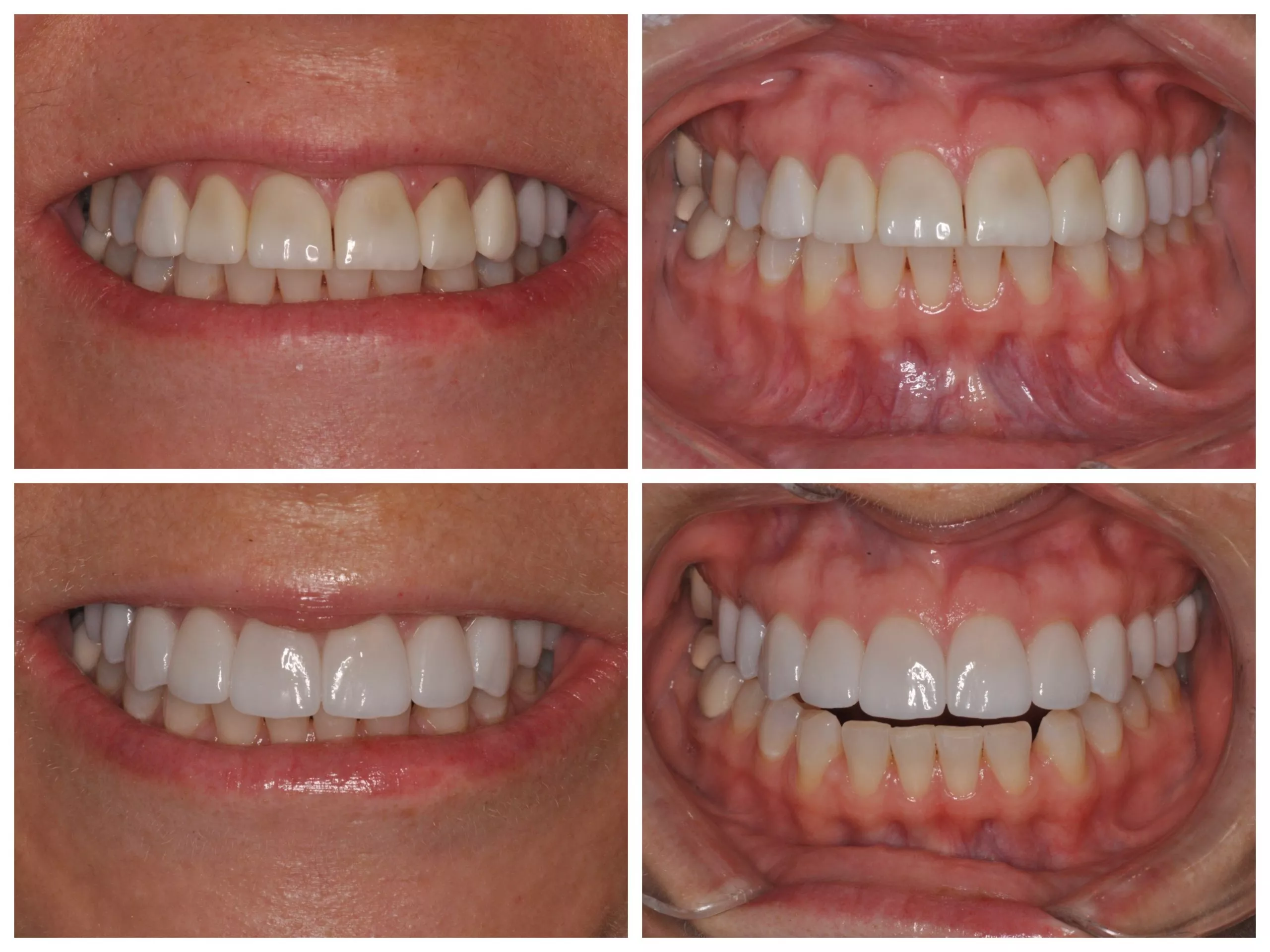 經修磨後安裝牙齒貼片的術後近拍照