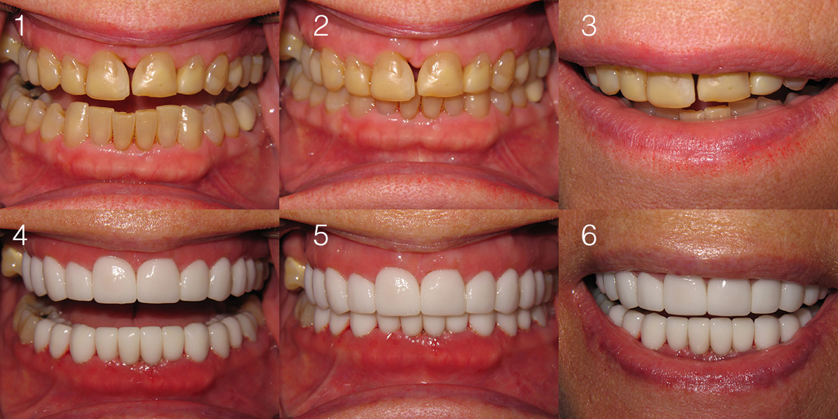 使用陶瓷貼片的前後對比圖。