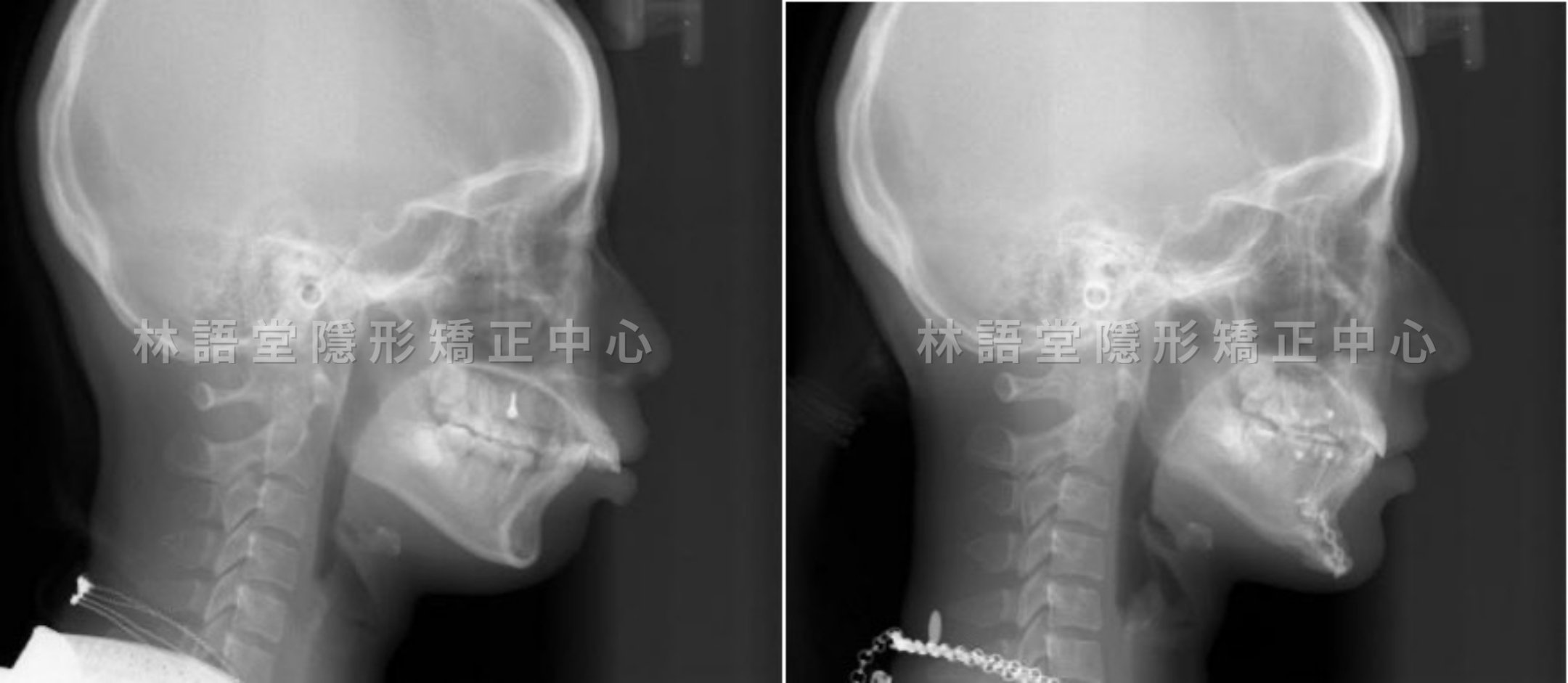矯正案例:成人下顎骨後縮、明顯暴牙、突嘴.jpg