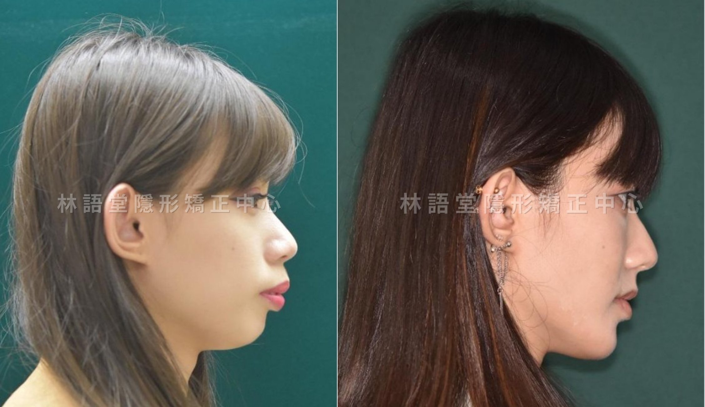 矯正案例:成人下顎骨後縮、明顯暴牙、突嘴.jpg