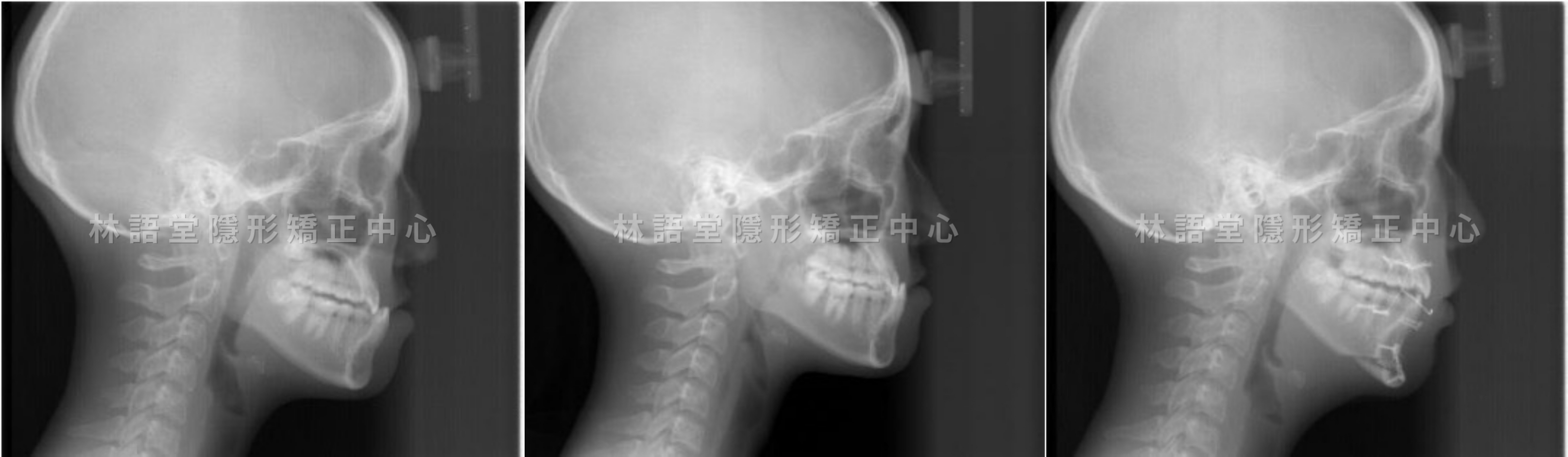 矯正案例:兒童戽斗、錯咬.png