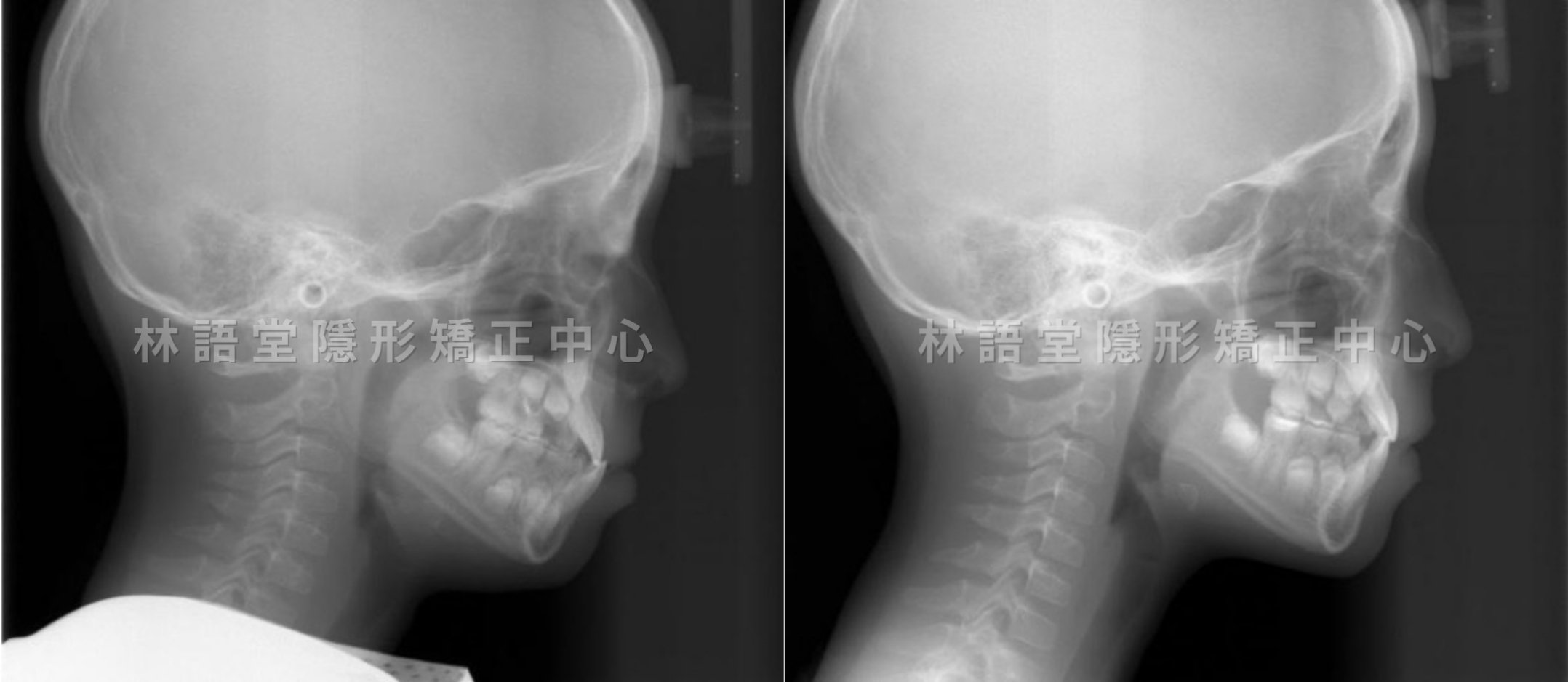 矯正案例:兒童戽斗、錯咬.jpg