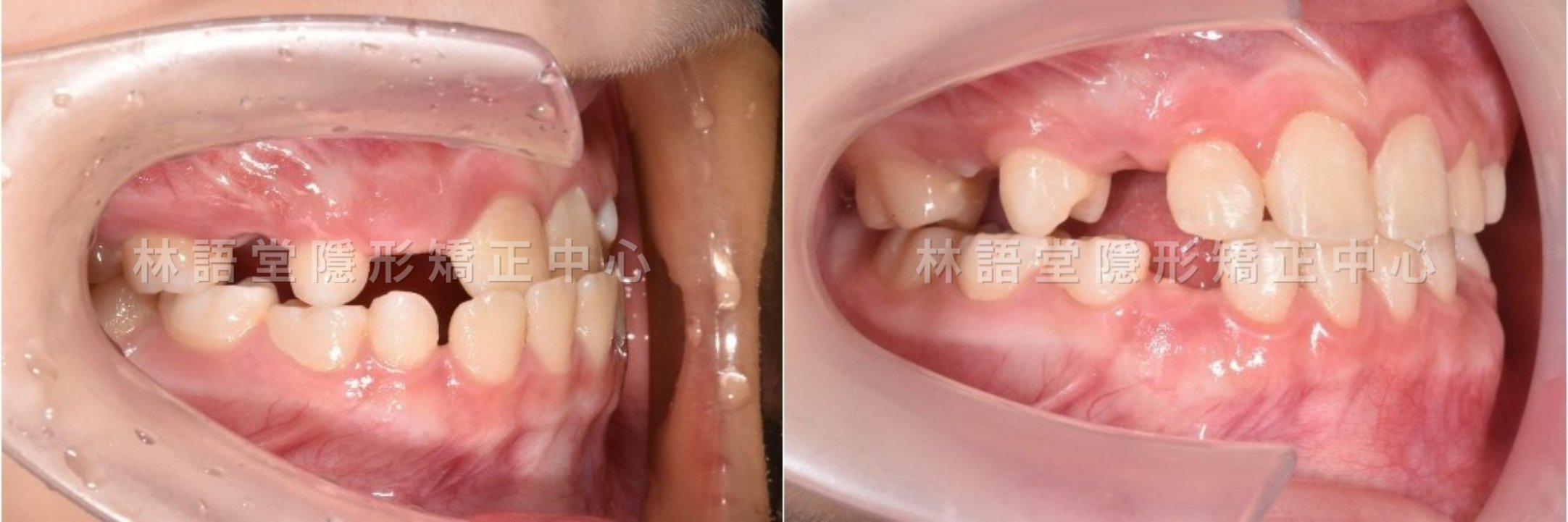 矯正案例:兒童戽斗、錯咬.jpg