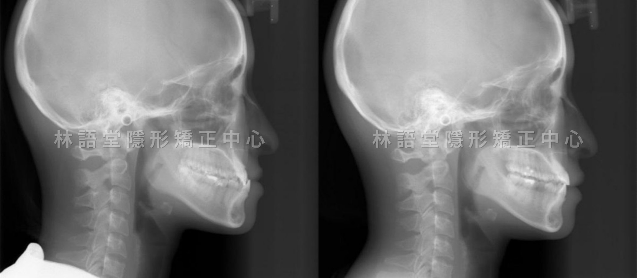 矯正案例:成年戽斗、錯咬.jpg