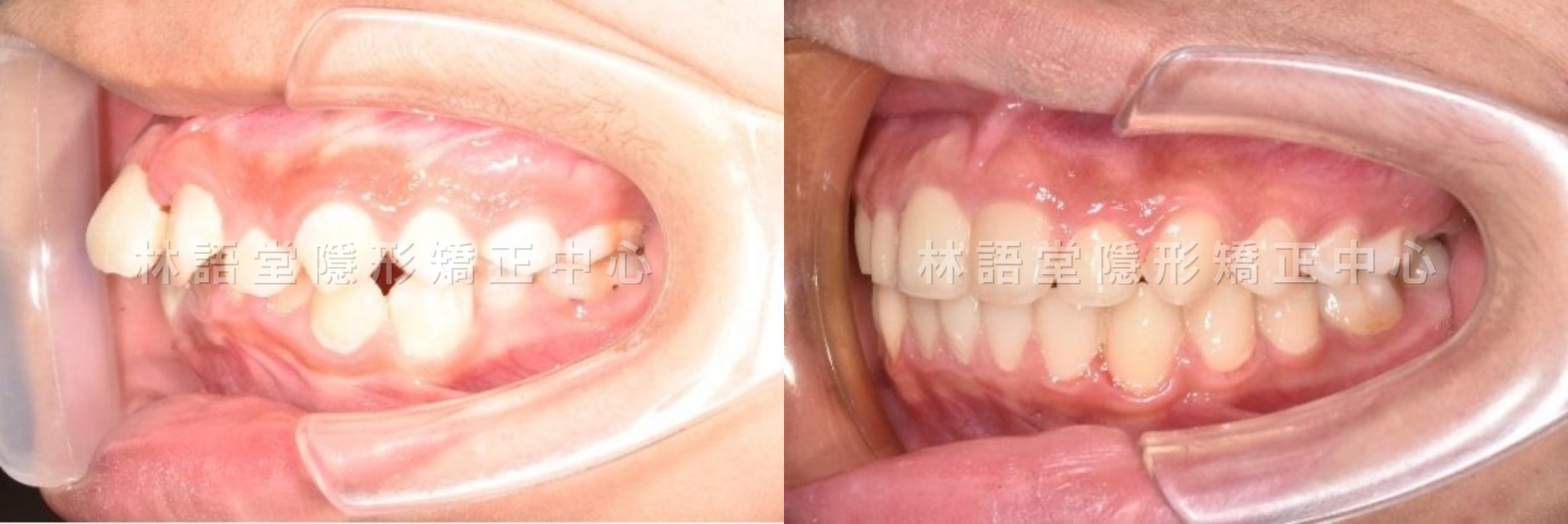 矯正案例:兒童下顎骨後縮、牙齒擁擠、嘴巴閉不起來.jpg