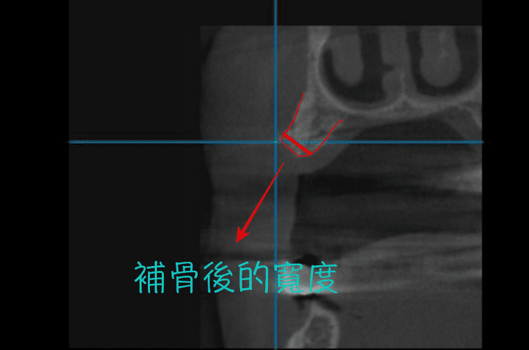 植牙補骨後.png