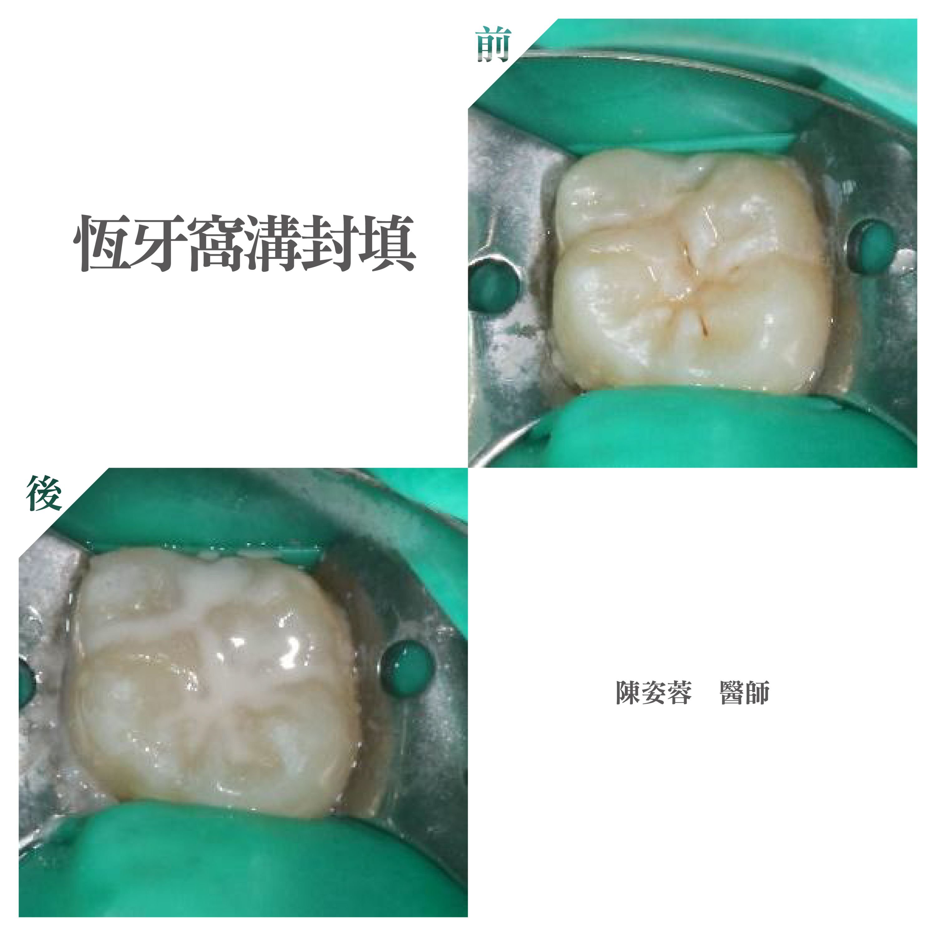 台北兒童牙醫推薦 - 兒童恆牙窩溝封填 - 小小怡登.jpg