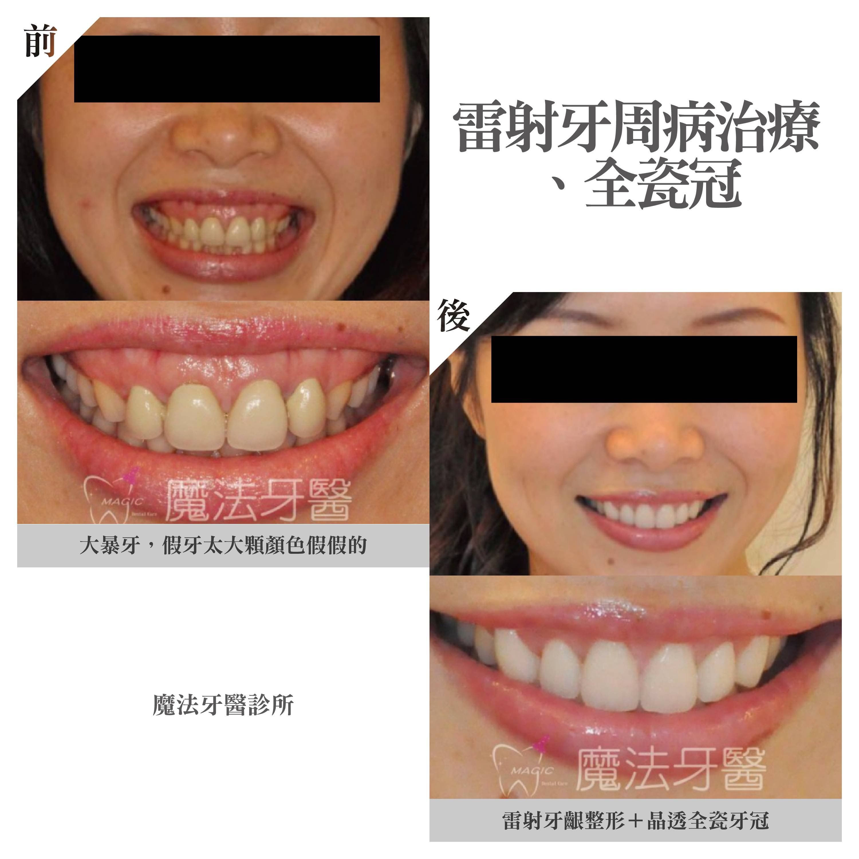 雷射牙周病治療+全瓷冠-大圖.jpg
