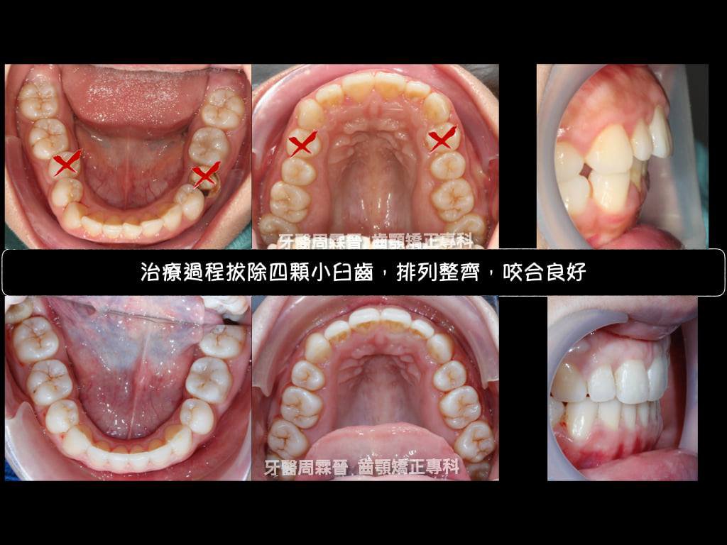 拔牙矯正 - 前後對比1.jpg