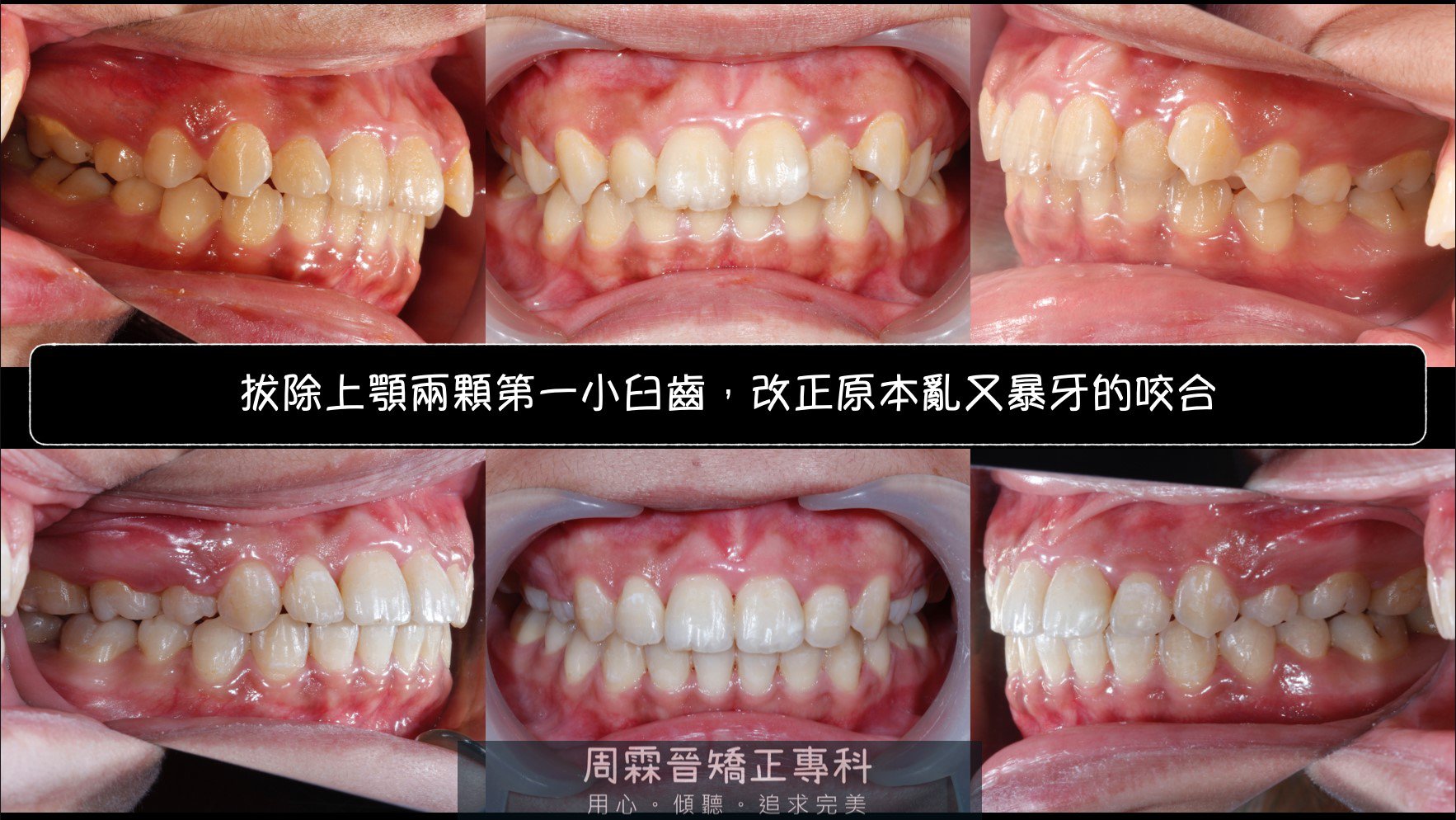 拔牙矯正 - 前後對比.jpg