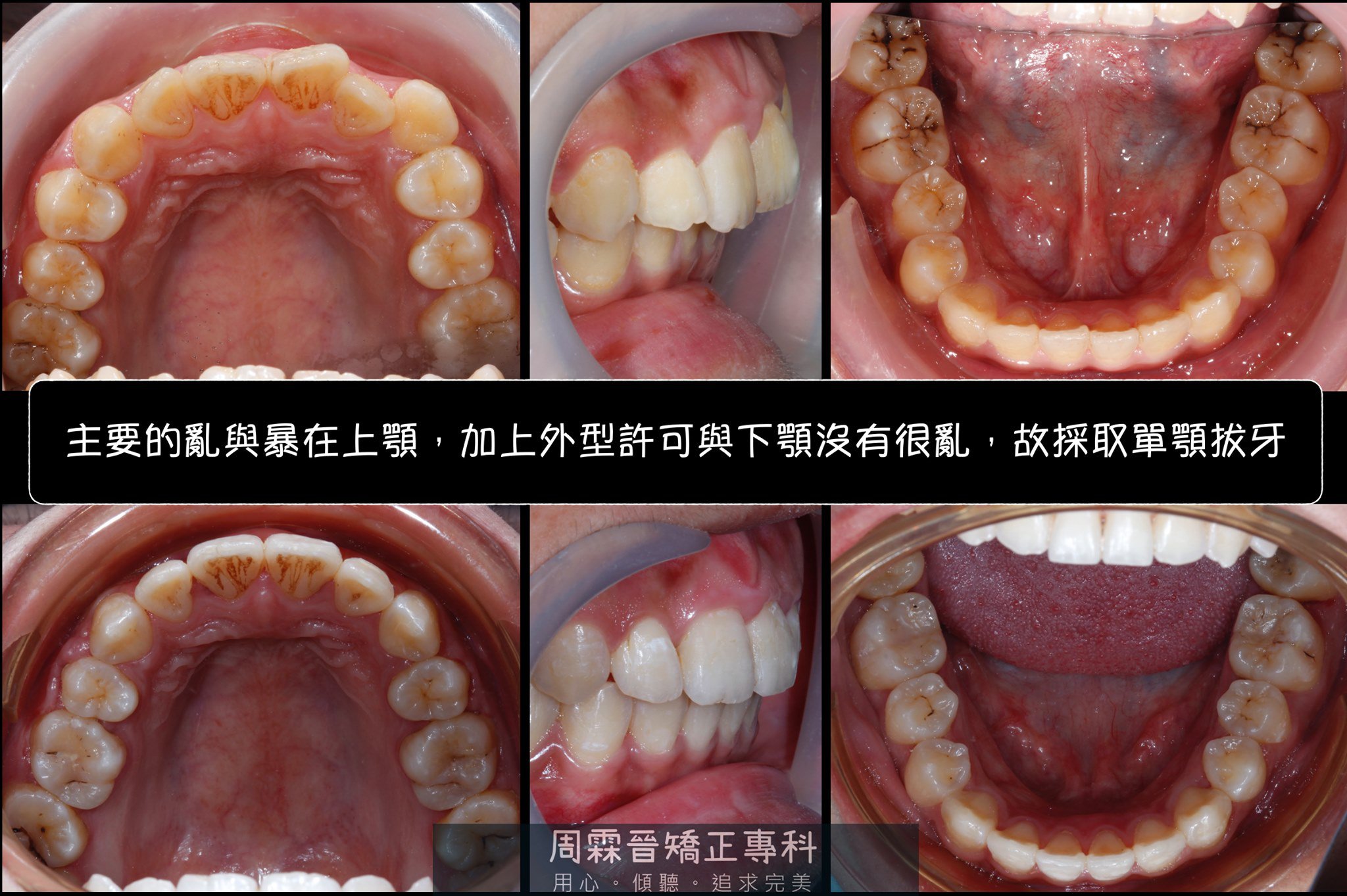 拔牙矯正 - 前後對比.jpg