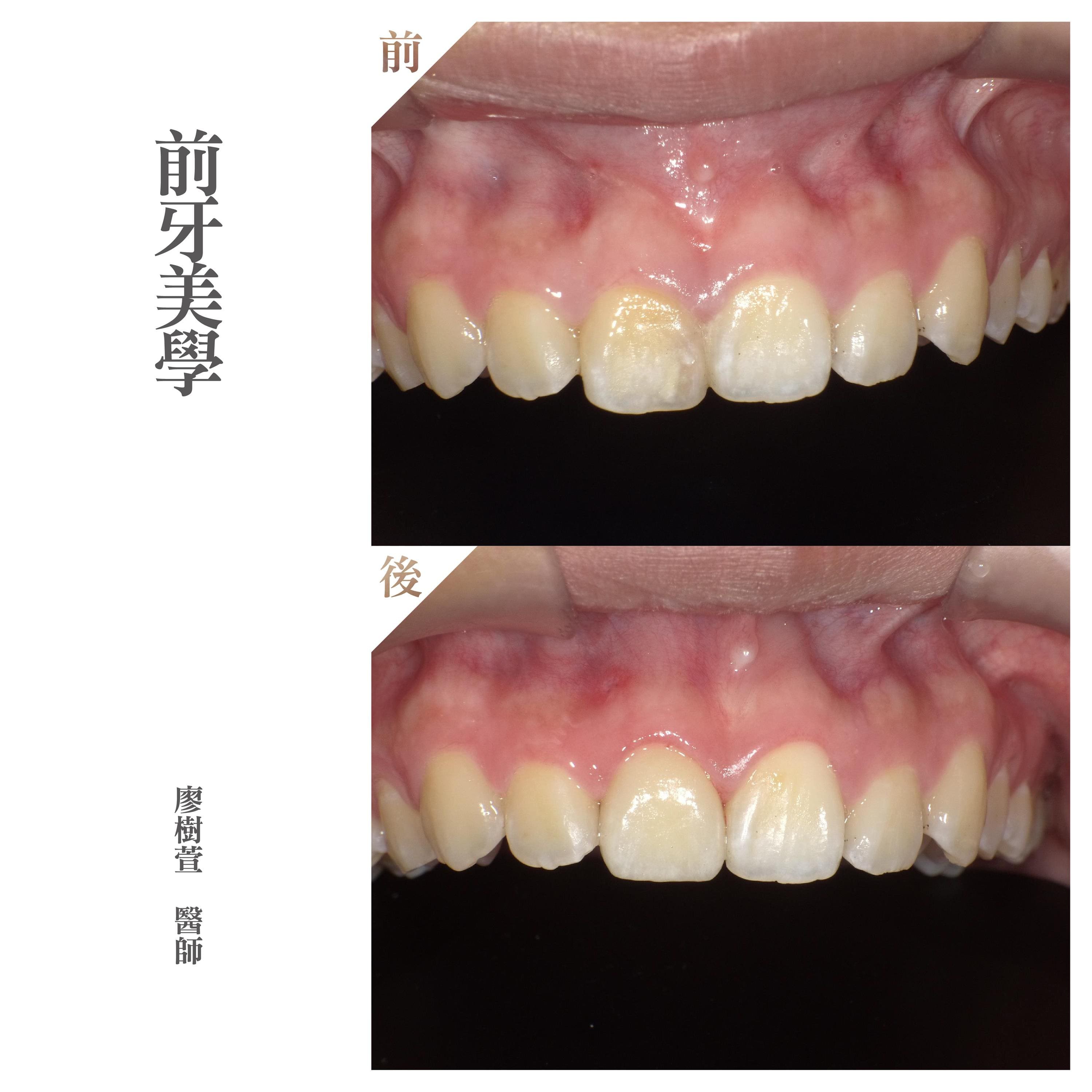 牙齒美白推薦 - 前牙美學 - 廖樹萱醫師.jpg