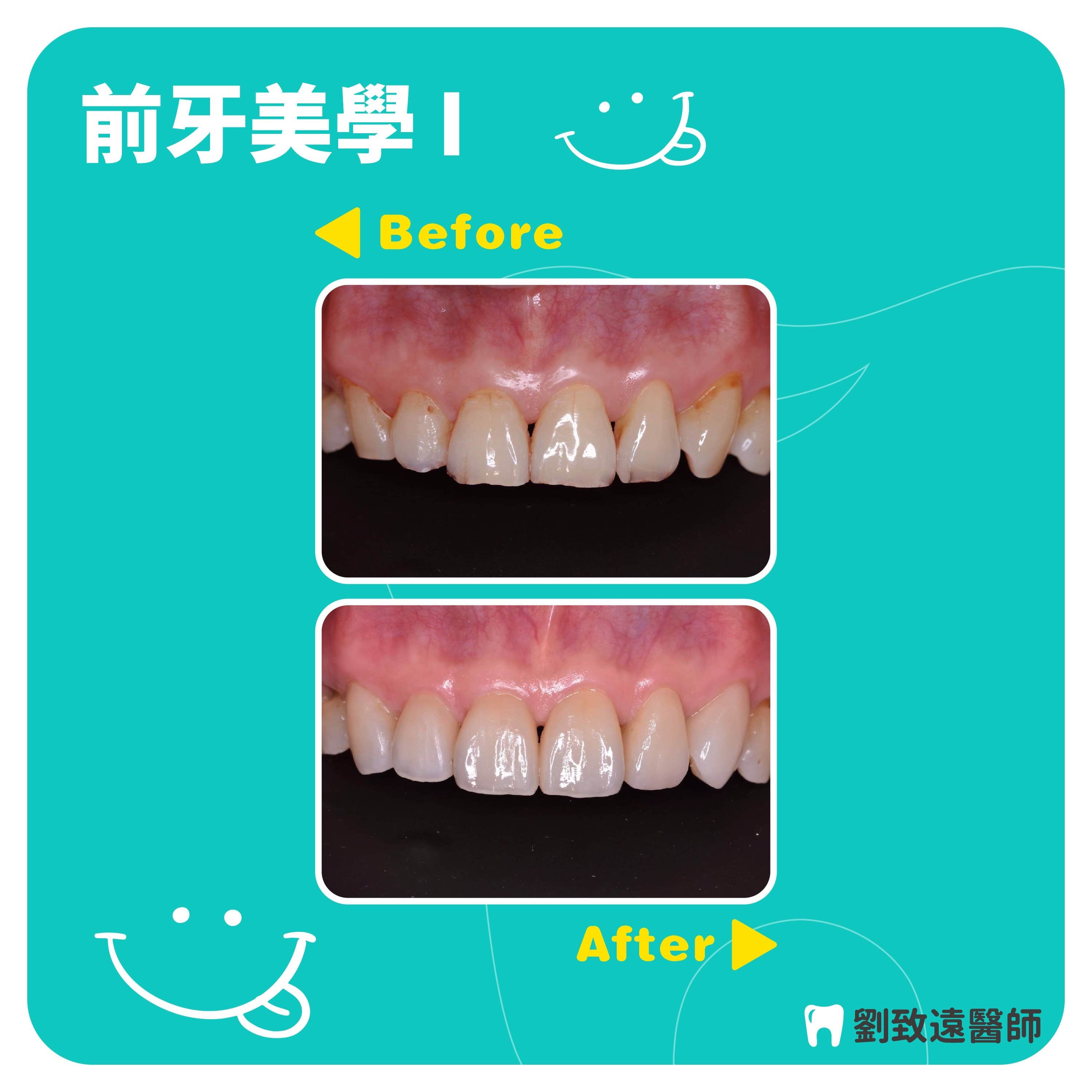 美白貼片推薦 - 前牙美學案例.jpg