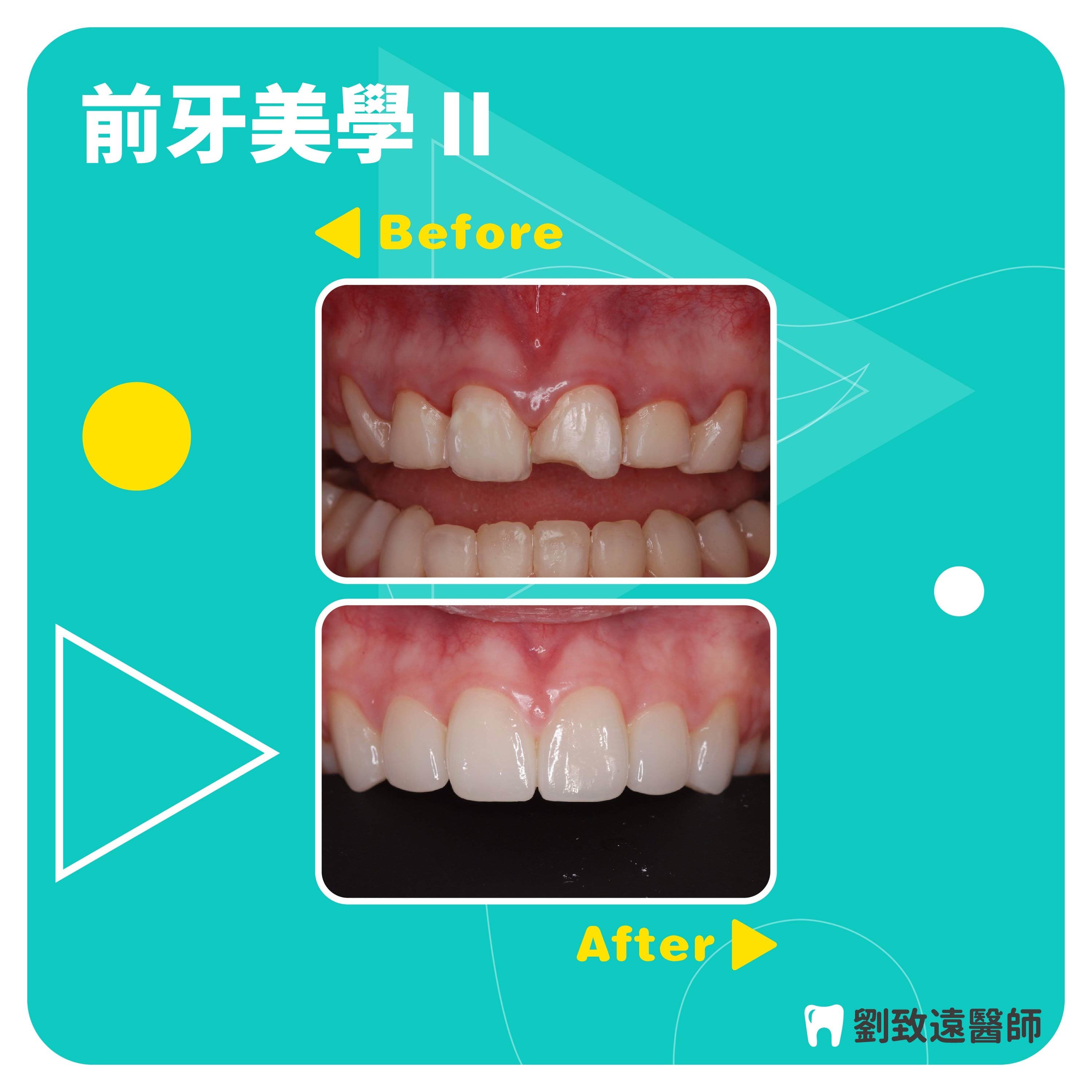 美白貼片推薦 - 前牙美學 2.jpg
