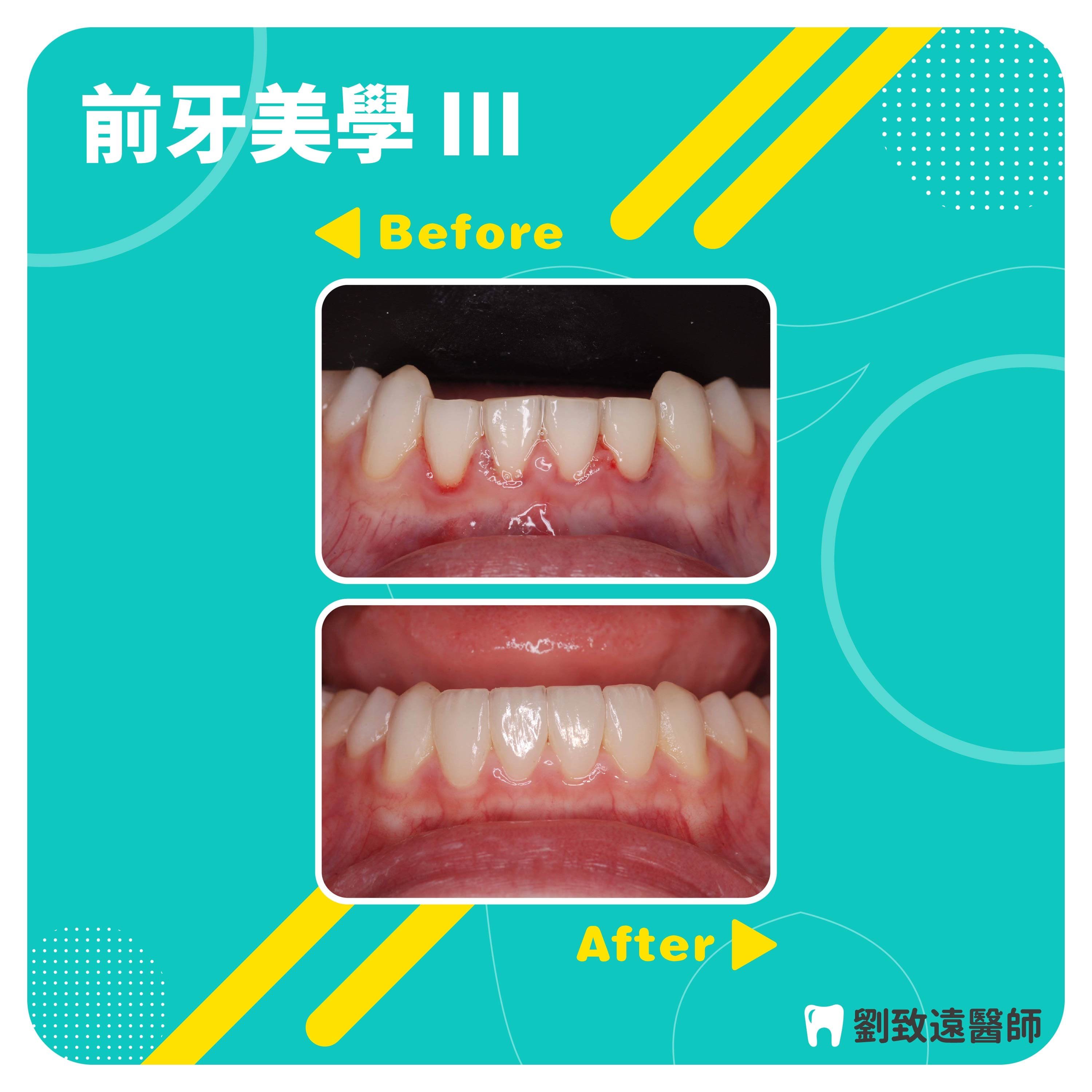 美白貼片推薦 - 前牙美學 .jpg