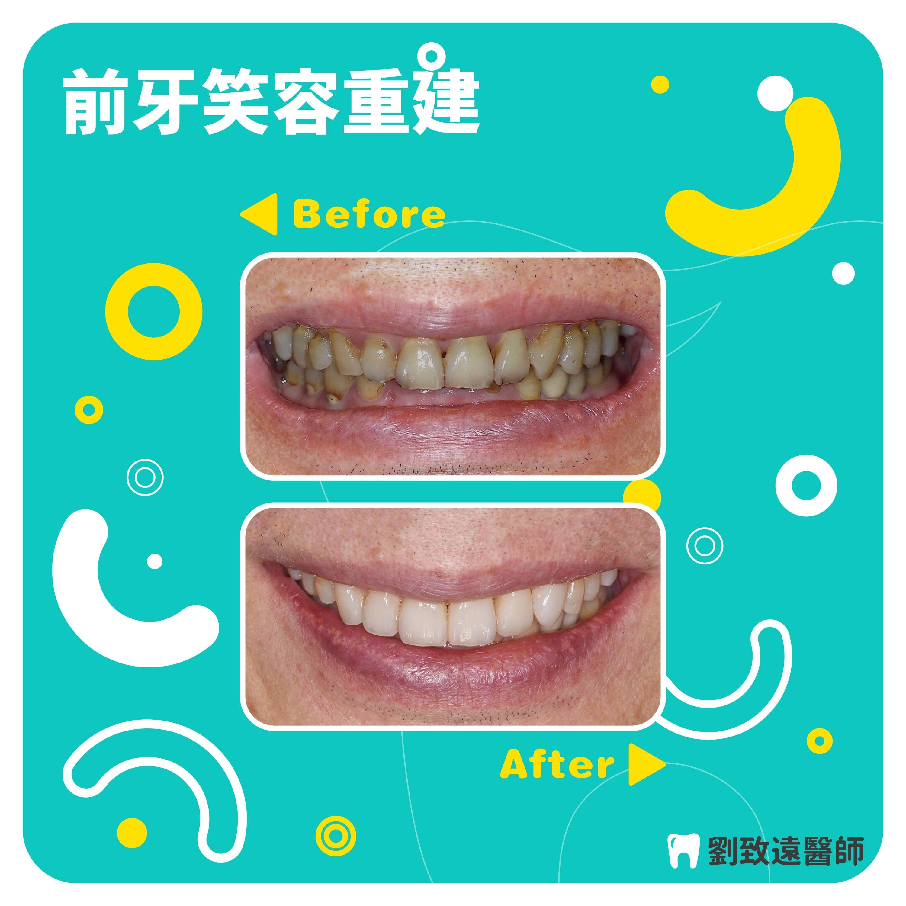 美白貼片推薦 - 前牙笑容重建.jpg