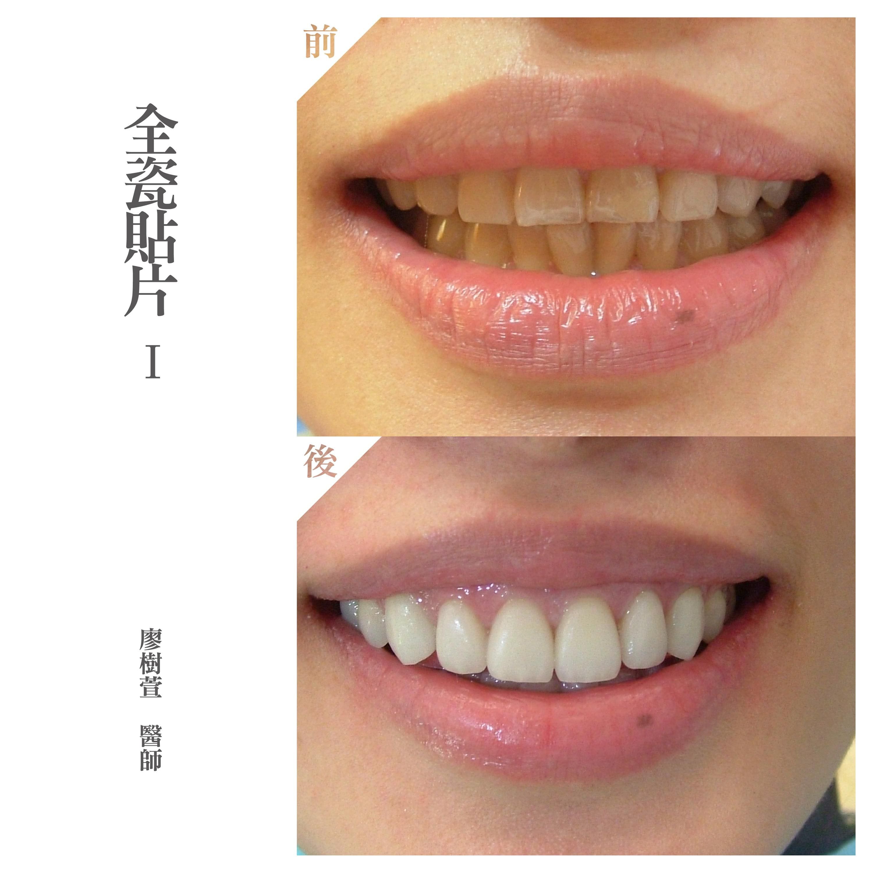美白貼片推薦 - 全瓷貼片- 廖樹萱醫師.jpg