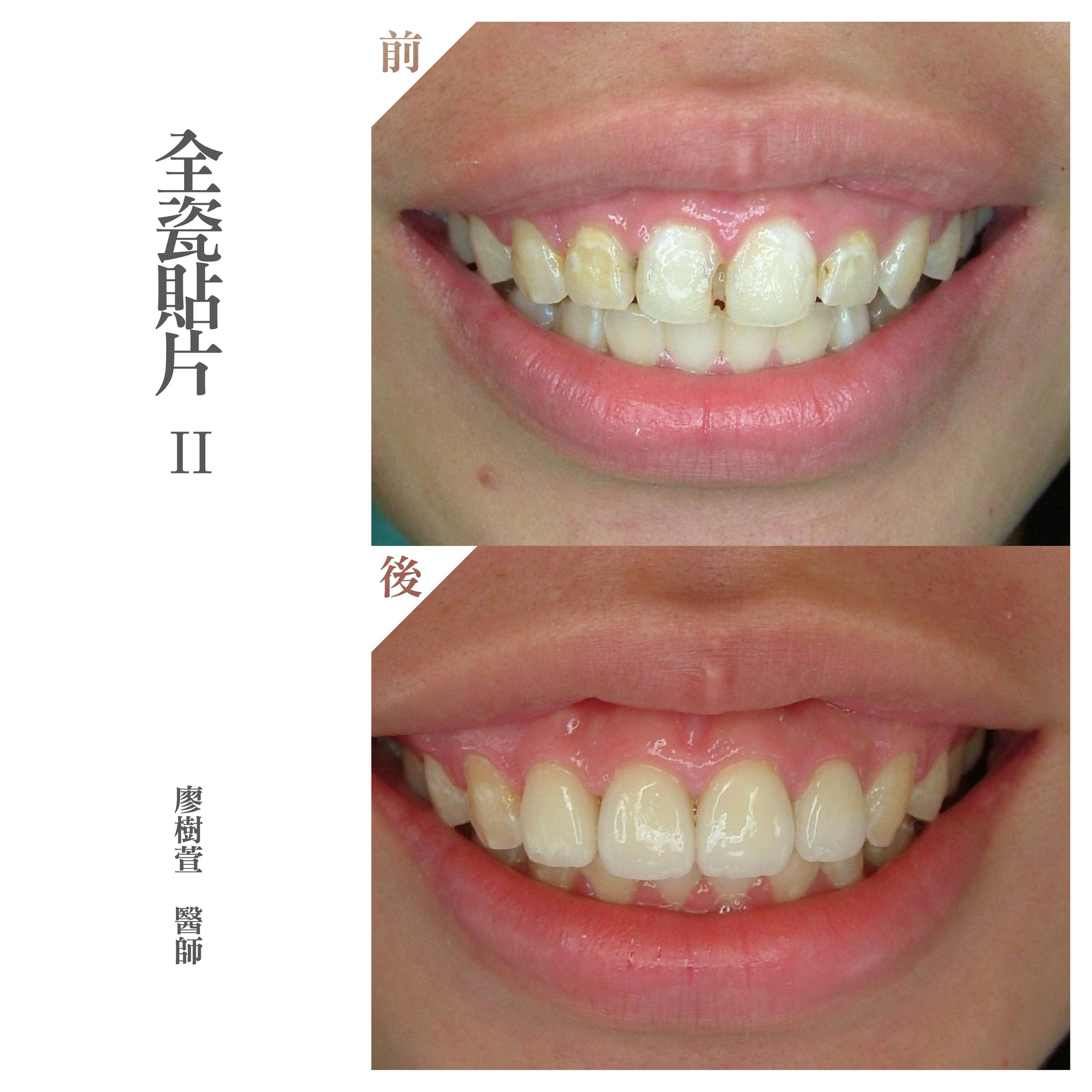 美白貼片推薦 - 全瓷貼片- 廖樹萱醫師.jpg