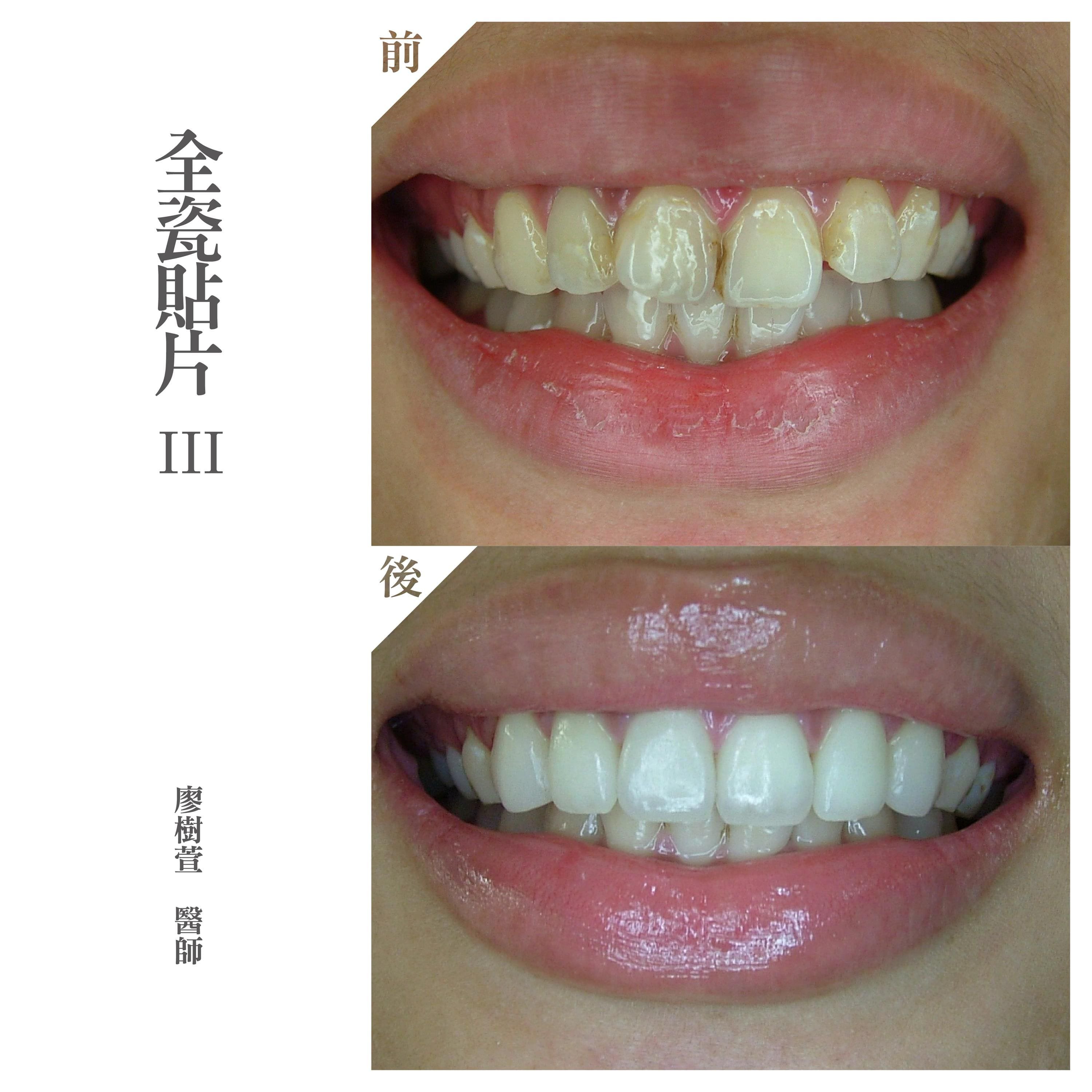 美白貼片推薦 - 全瓷貼片案例- 廖樹萱醫師.jpg
