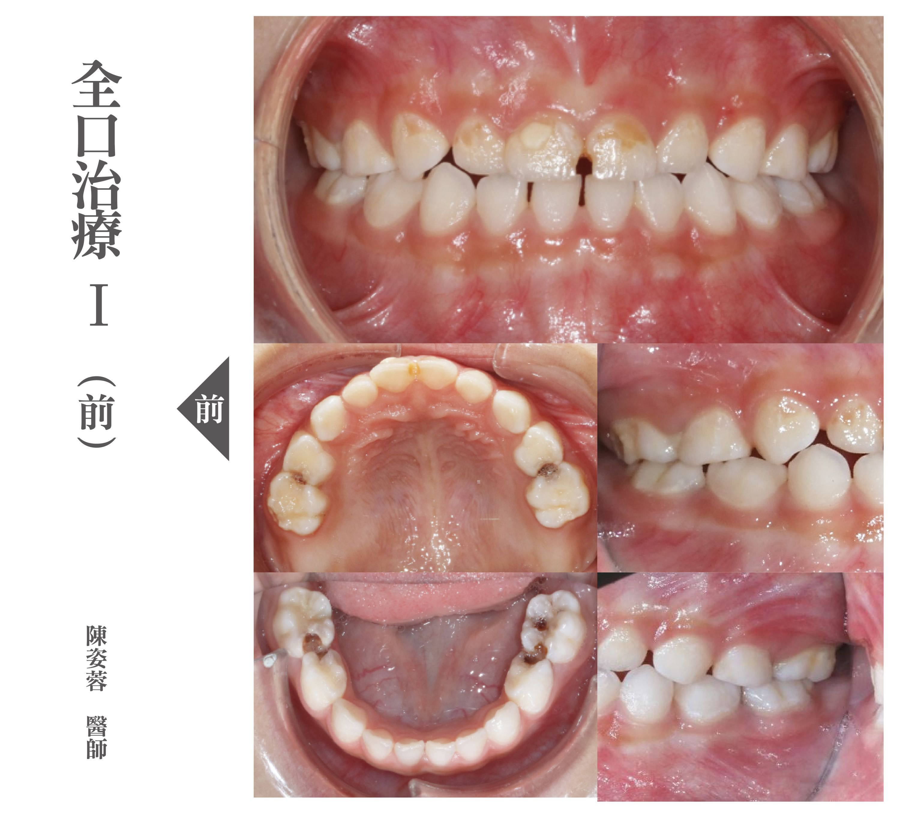 台北兒童牙醫推薦 - 兒童全口蛀牙治療.jpg