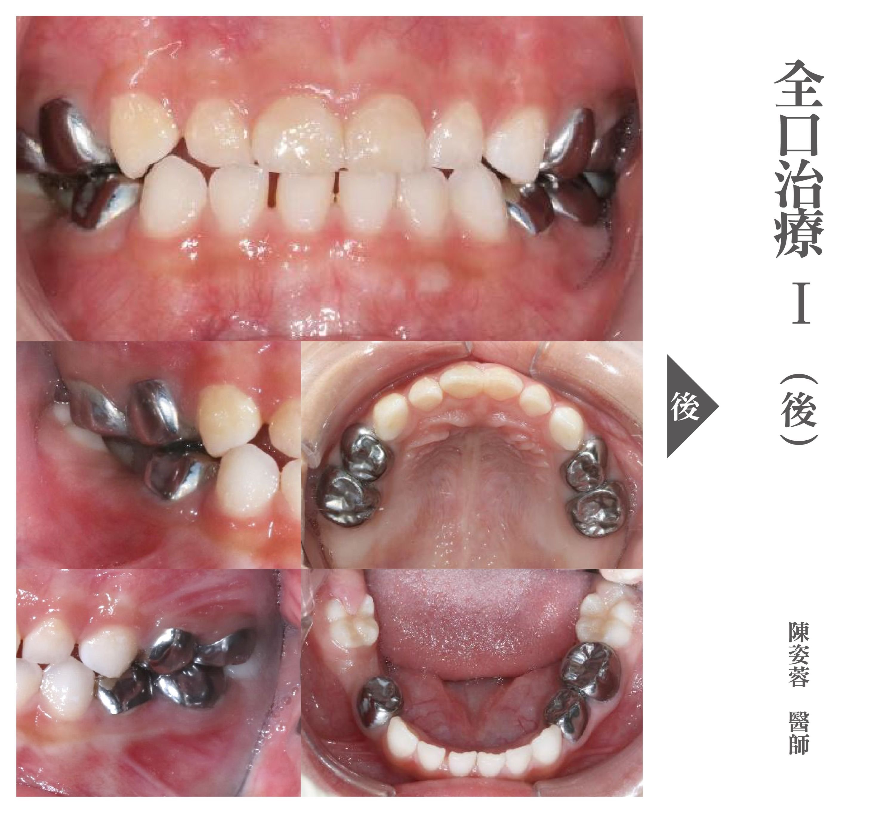 台北兒童牙醫推薦 - 兒童全口蛀牙治療.jpg