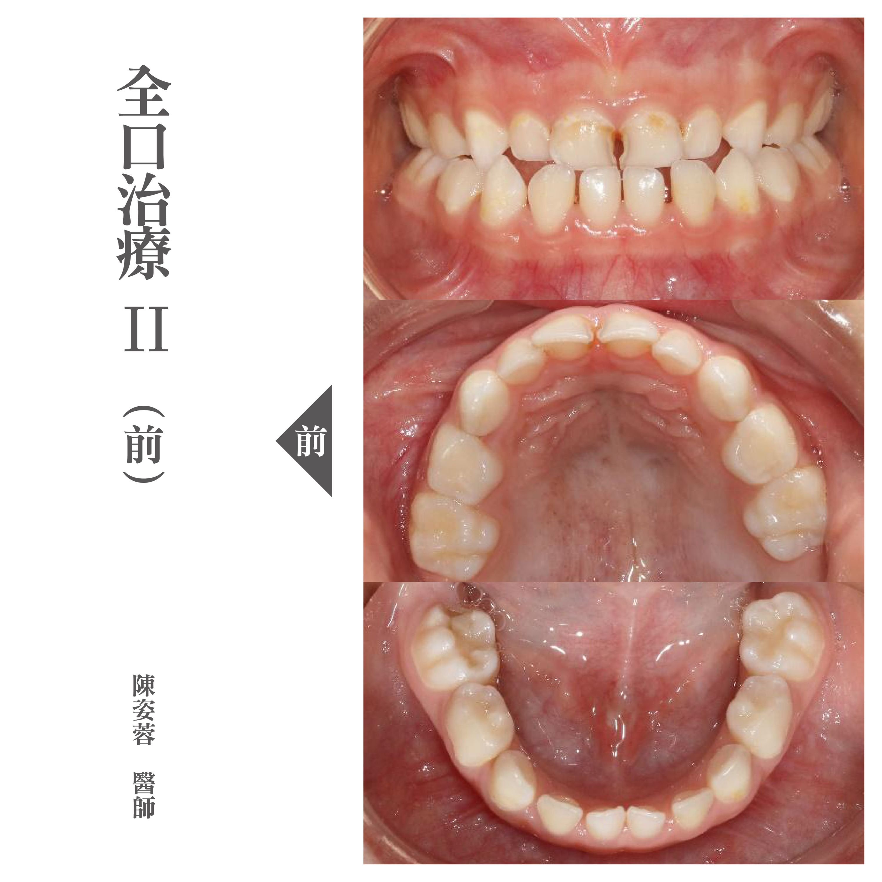 台北兒童牙醫推薦 - 兒童全口蛀牙治療.jpg