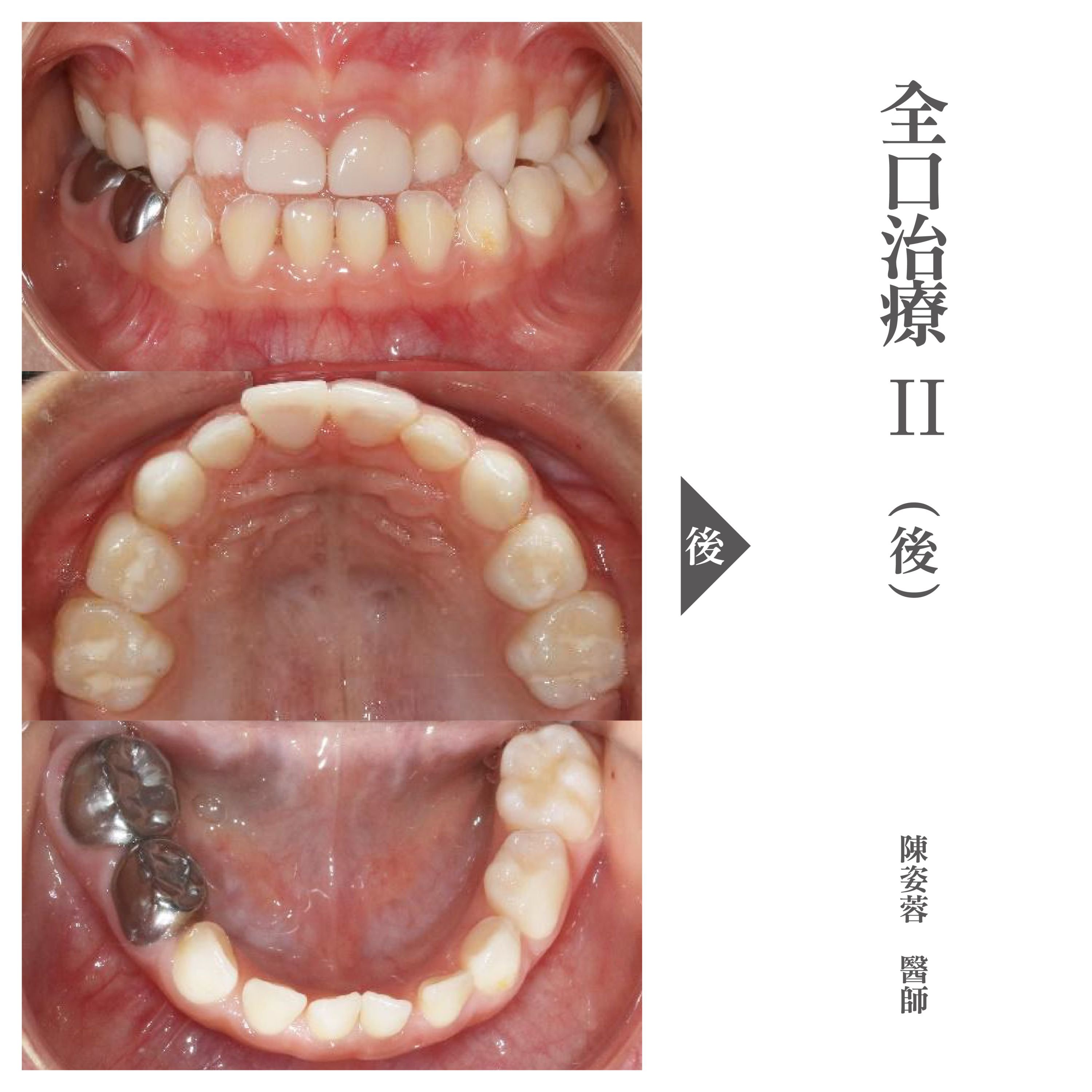 台北兒童牙醫推薦 - 兒童全口蛀牙治療- 小小怡登.jpg