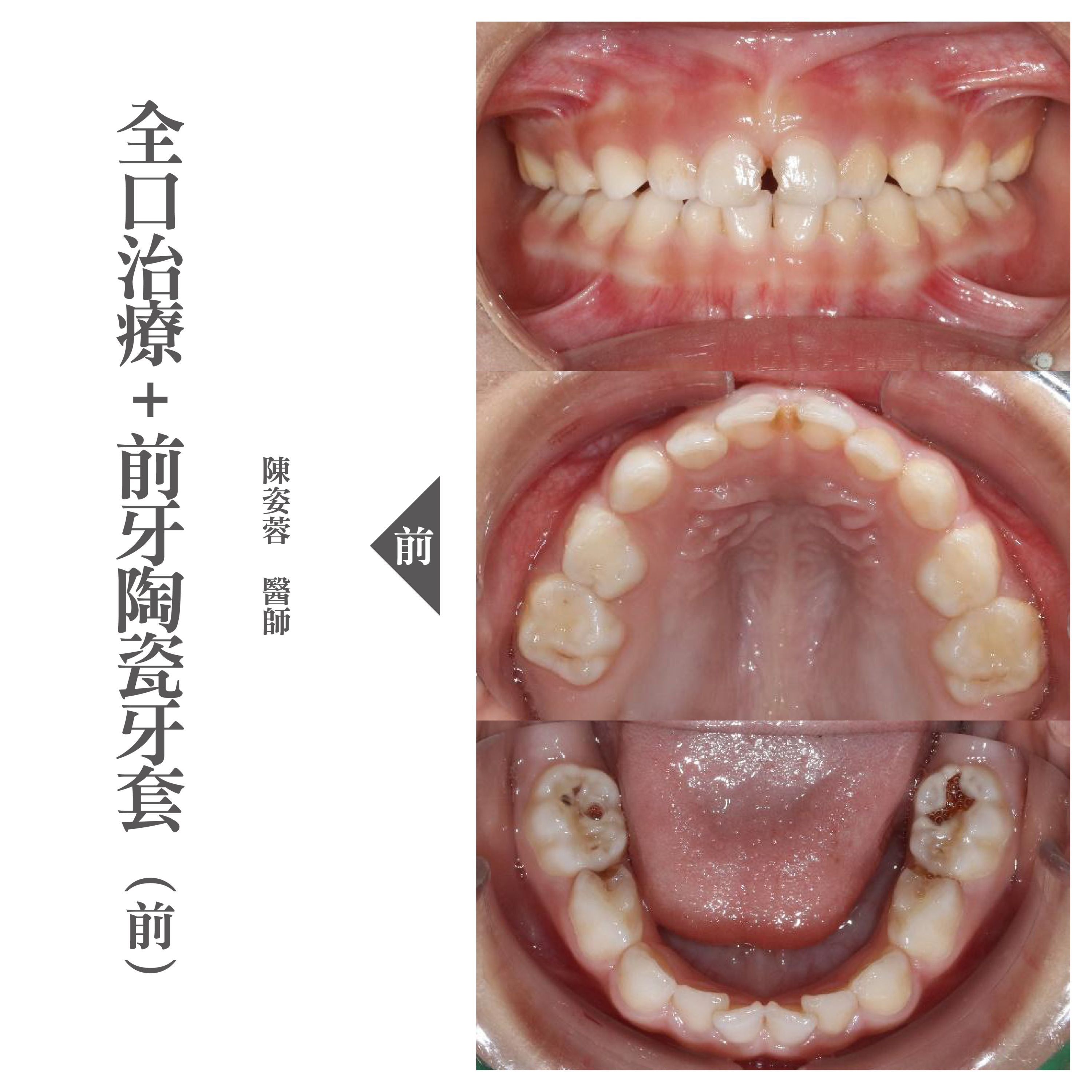 台北兒童牙醫推薦 - 兒童蛀牙全口治療+前牙陶瓷牙套- 小小怡登.jpg