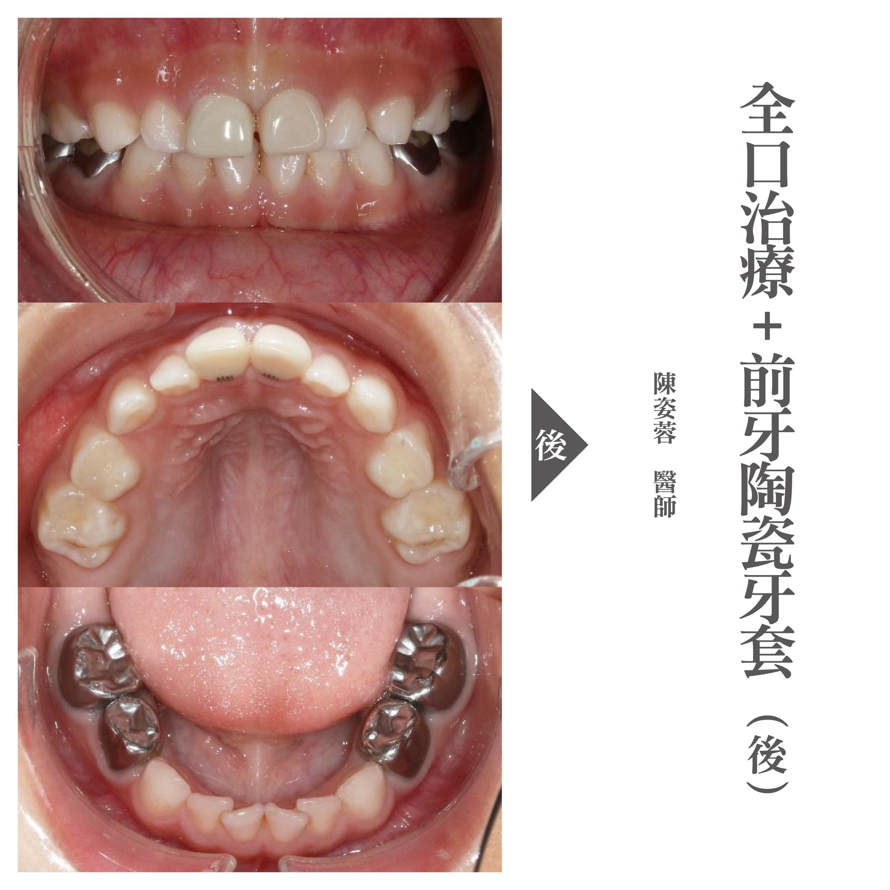 台北兒童牙醫推薦 - 兒童全口蛀牙治療+前牙陶瓷牙套 - 小小怡登02.jpg