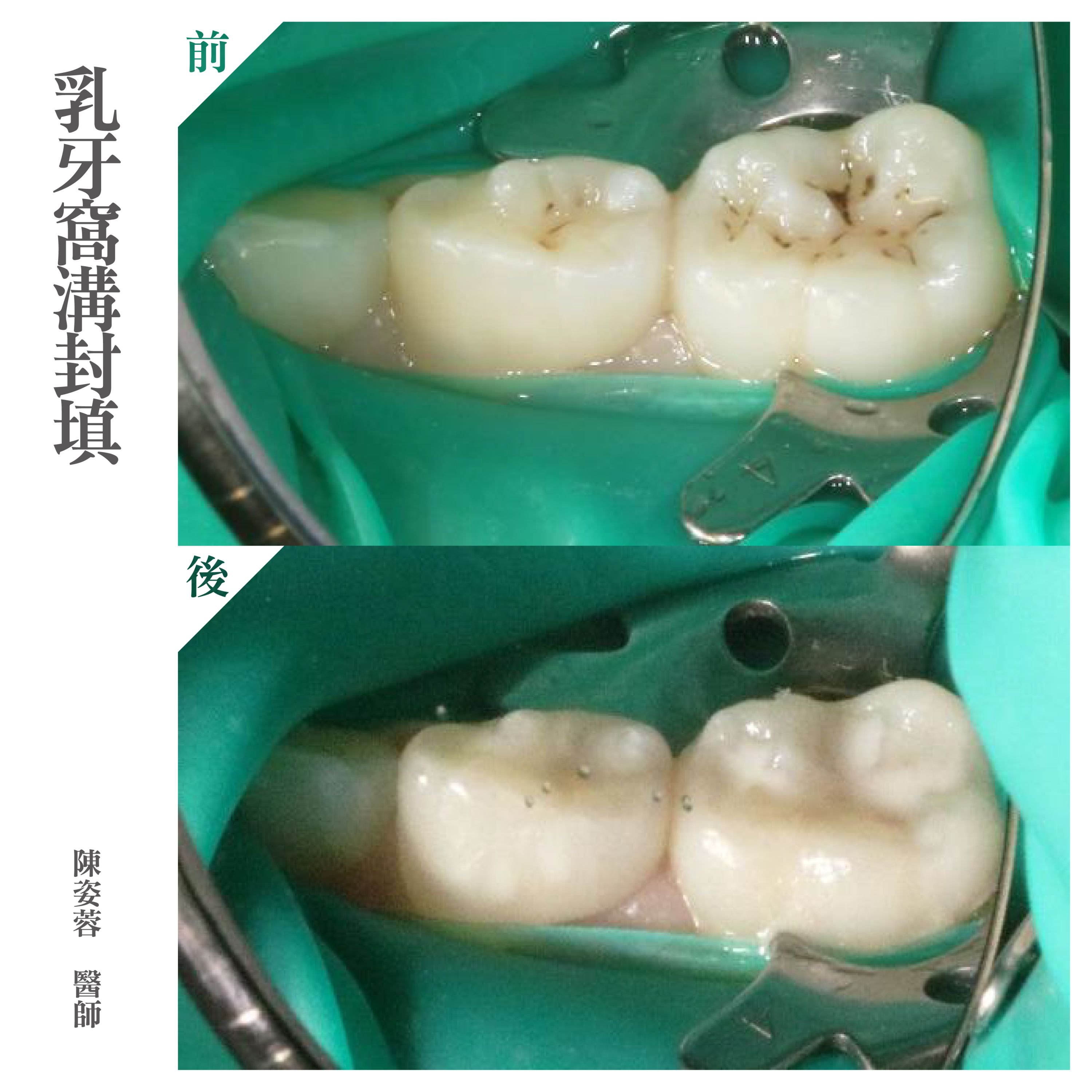 台北兒童牙醫推薦 - 兒童乳牙窩溝封填.jpg