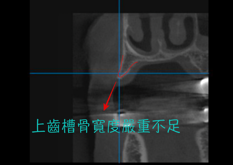 植牙補骨前.png