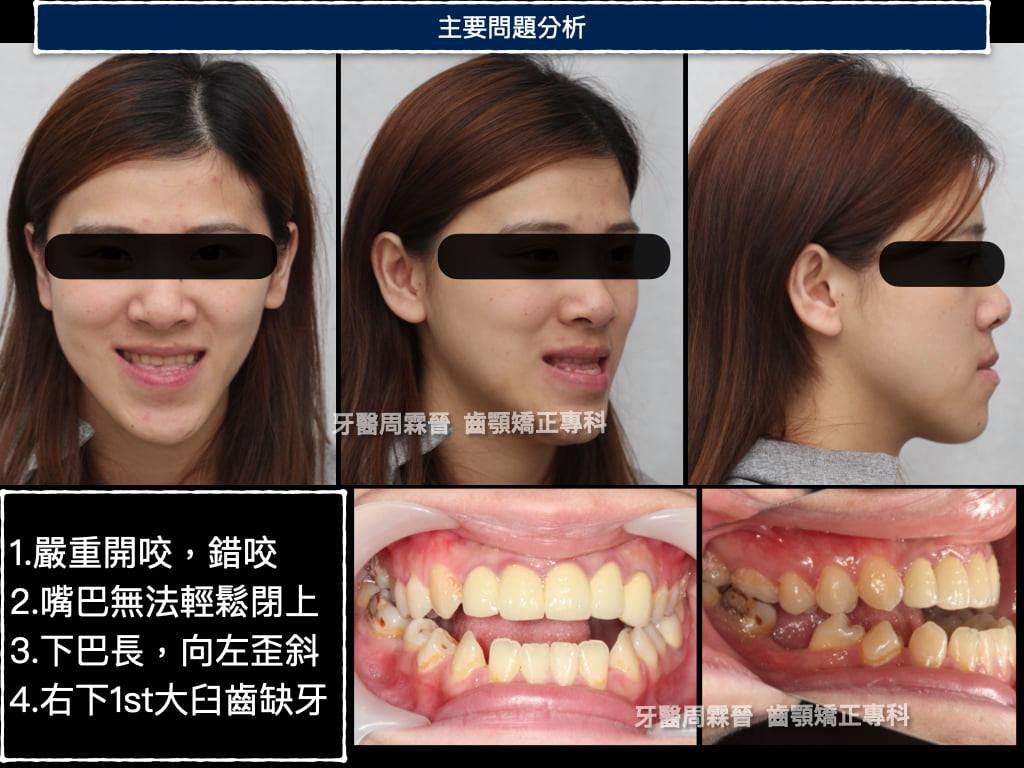 戽斗矯正 - 外型前後對比照.jpg